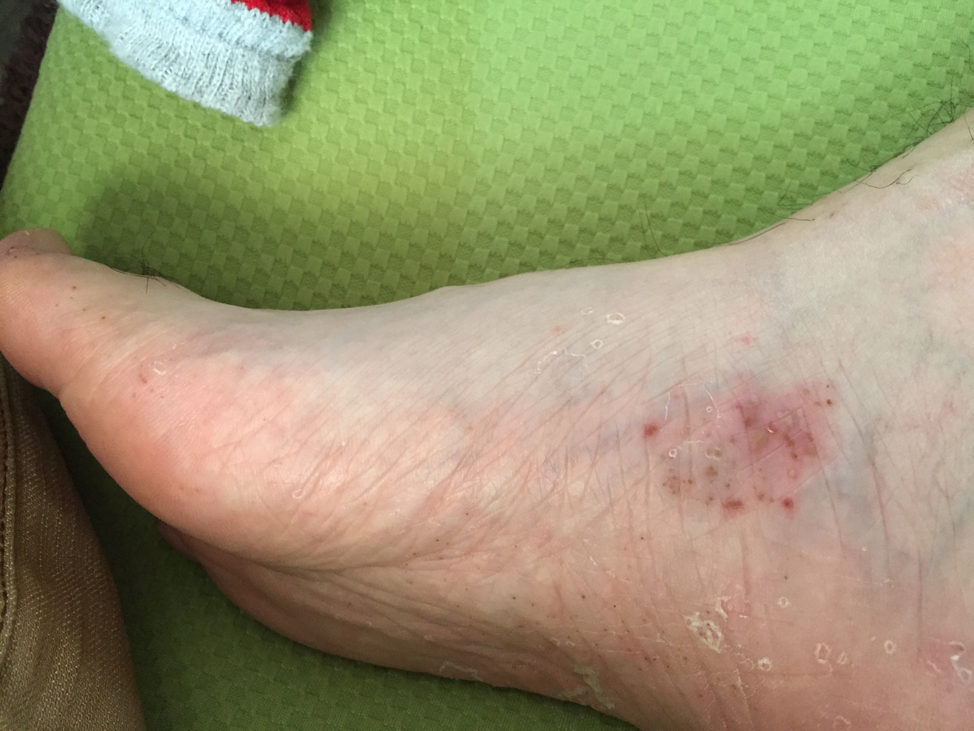 足の裏が痒い～しかも何か赤いんだけど、なんだこれ？ 掌蹠膿疱症はこの治療方法で完治する！